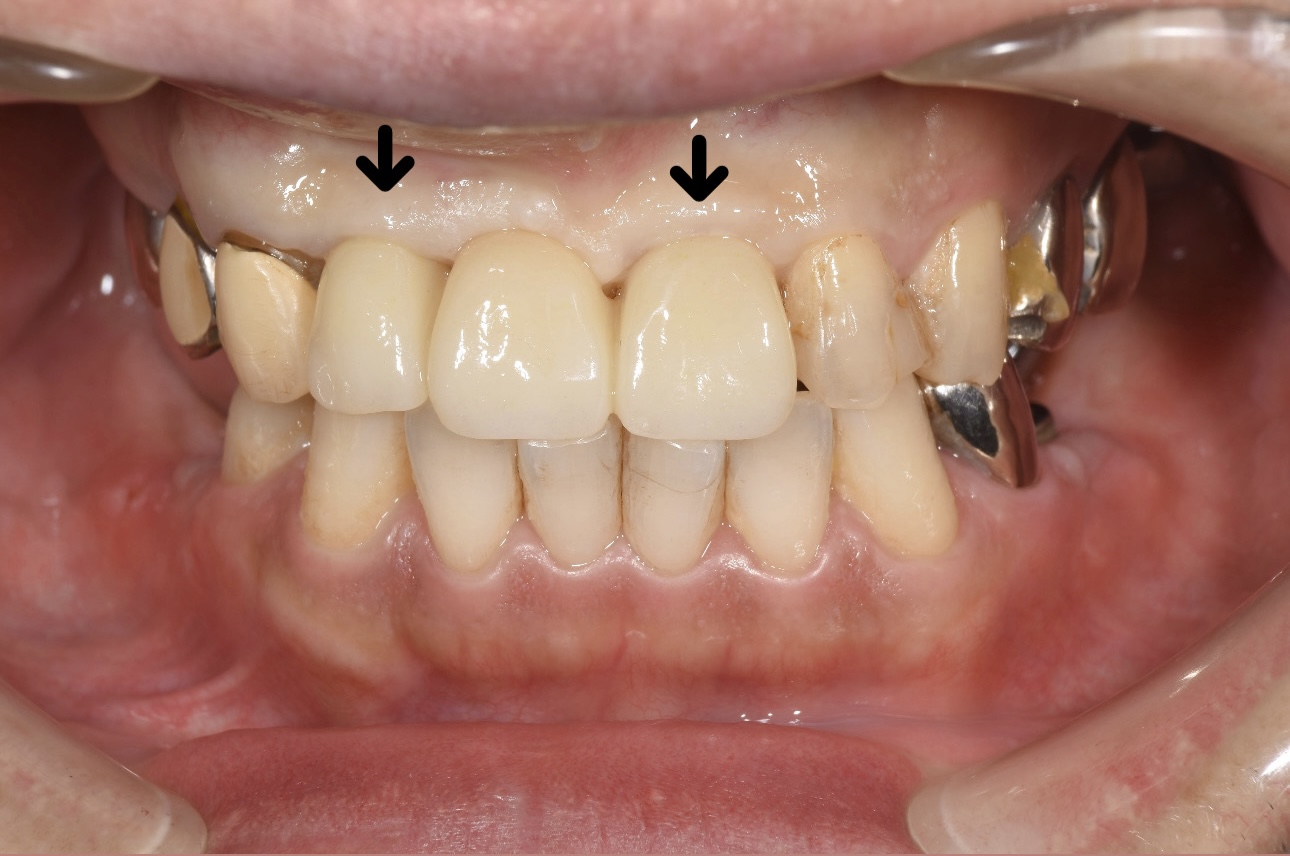 前歯のインプラントブリッジ