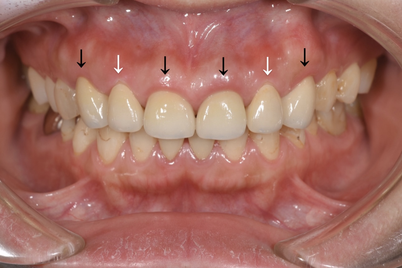 ガミースマイルを歯冠長延長術とセラミックで治療